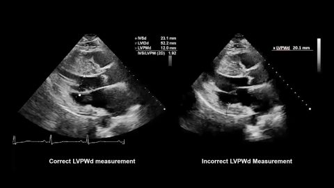 How to Measure Wall Thickness with Echocardiography