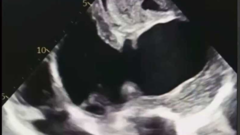 Lateral Wall of LV Pseudoaneurysm